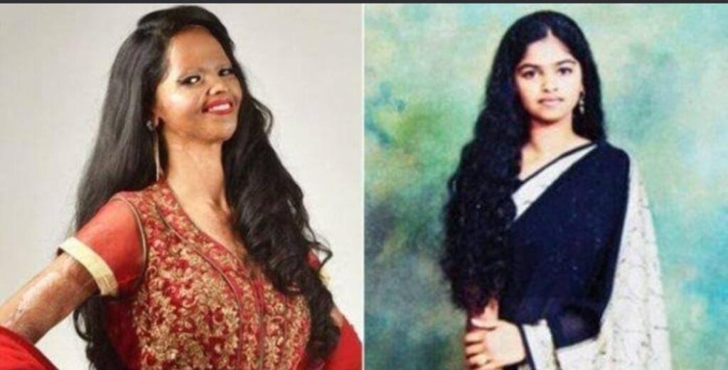Picture of laxmi agarwal before and after the acid attack.